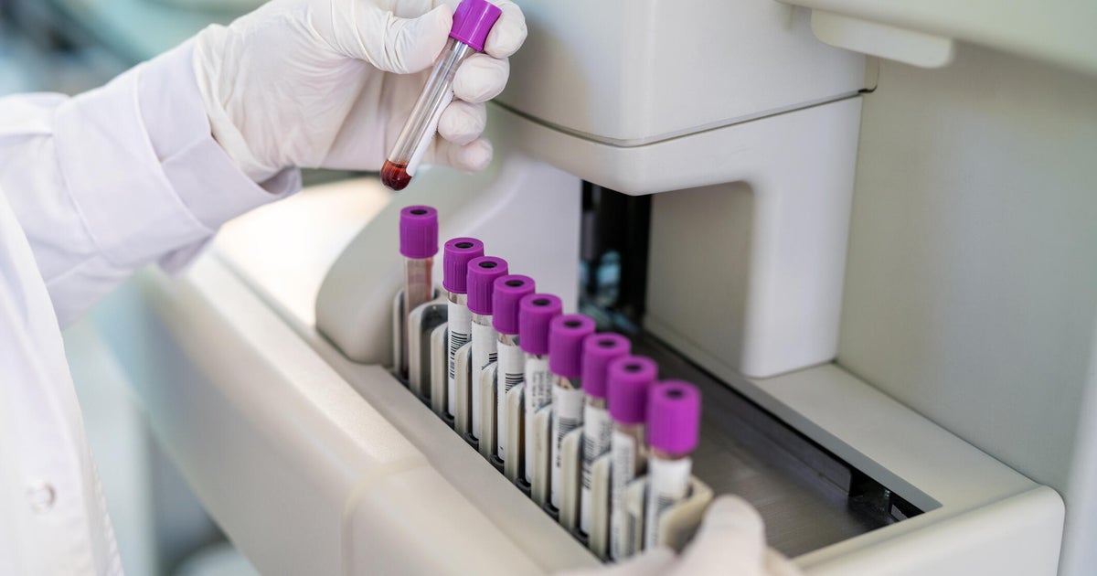 FDA Approves First Alzheimer’s Blood Test for Select Patients